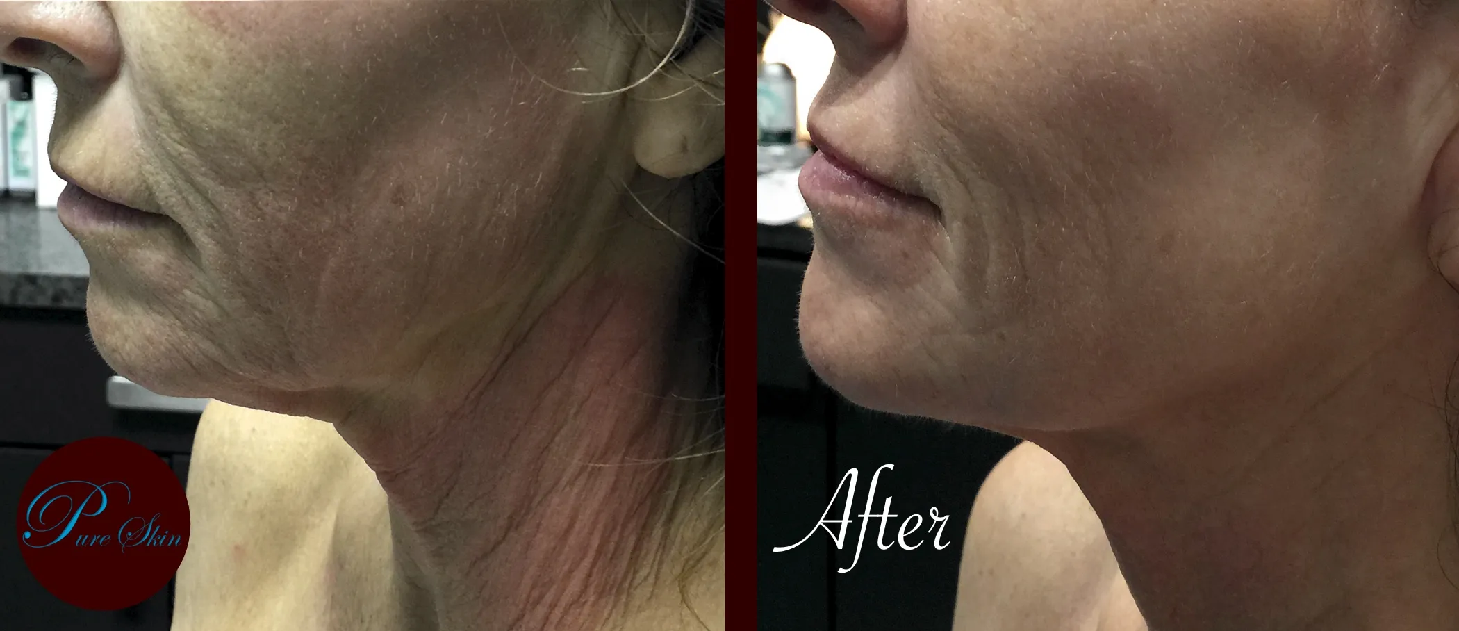 Before and after a microneedling series at PureSkin Dallas